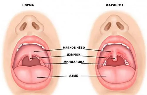 як лікувати гранулезний фарингіт