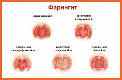 як лікувати гранулезний фарингіт