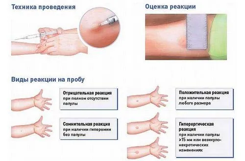 туберкульоз у дітей