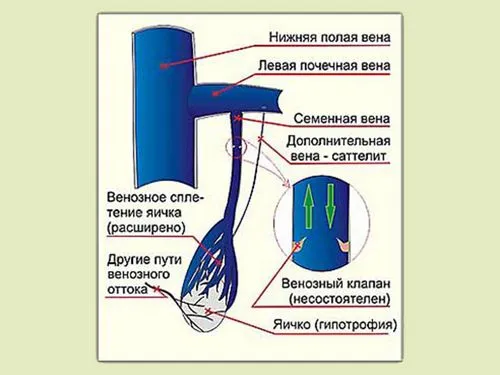 варикоцеле у підлітків лікування