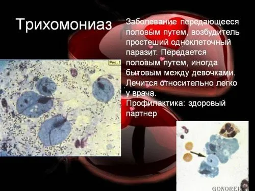як лікувати трихомоніаз і гонорею