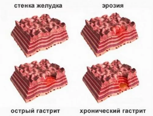 вогнищевий атрофічний гастрит дієта