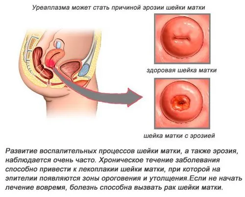 як лікувати уреаплазму при ерозії
