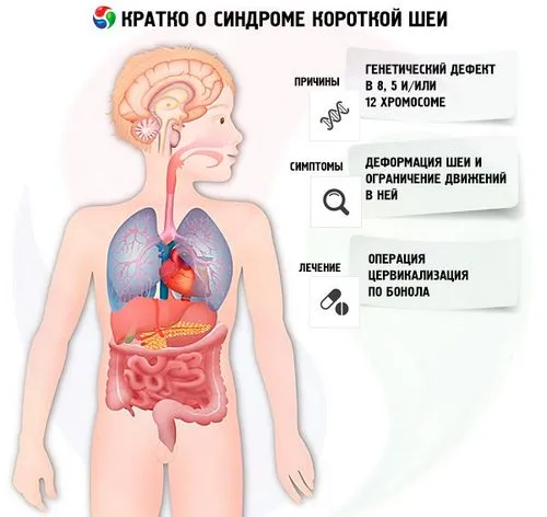 синдром Кліппеля Фейль