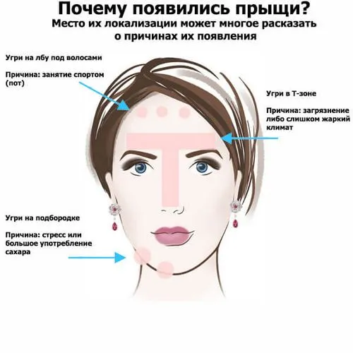 як лікувати прищі від нервів