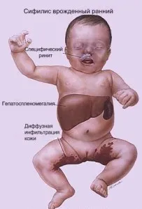 як вилікувати пізній сифіліс