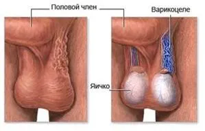 як лікувати варикоз в яєчках