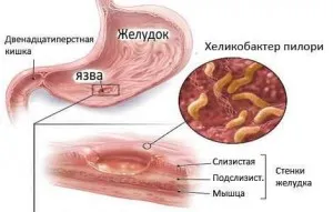 як лікувати метаплазию шлунка