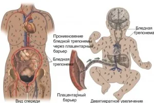 як вилікувати пізній сифіліс