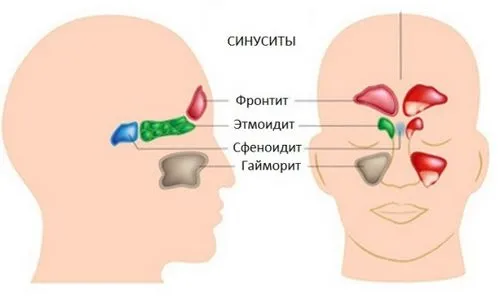 Викликає синусит кашель народне лікування синуситу