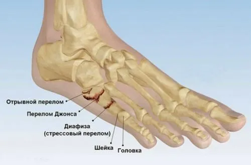 як швидко вилікувати забій стопи
