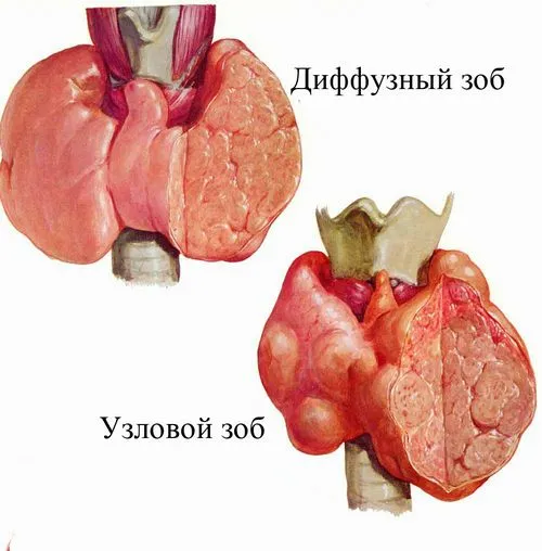 як лікувати зоб Хашимото