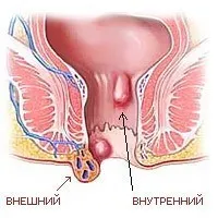 як позбутися від геморою під час вагітності