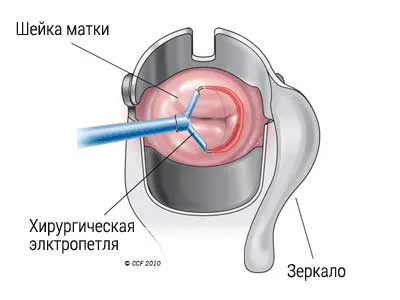 припікання ерозії шийки матки рідким азотом