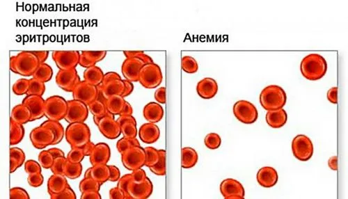 низький гемоглобін у вагітних наслідки