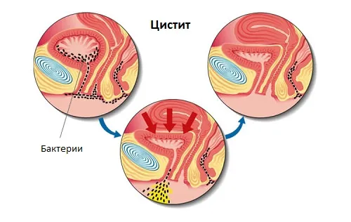 чи можна завагітніти при клімаксі