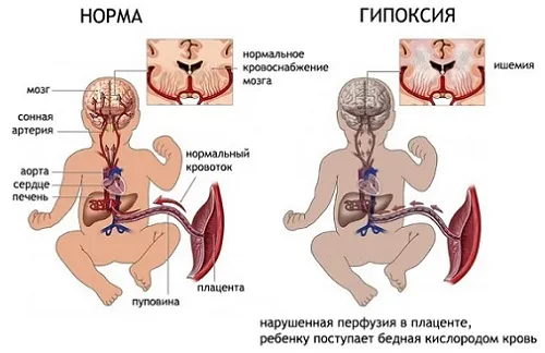 народні методи лікування нежиті у вагітних