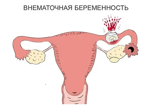 чи можна завагітніти при клімаксі