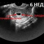 вагітність 6 тиждень