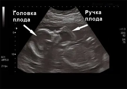 болі внизу живота