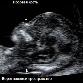 МПЦ, узі, впр, КБС, комбінований біохімічний скринінг, вагітність, порок розвитку, медичний пренатальний центр, Купчино, генетика, гінеколог, уролог, біохімічний скринінг, воронин, лабораторні дослідження, діагностика, фахівці, послуги, ультразвукова діагностика, плід, узі плода, інвазивна пренатальна діагностика, гомеопат, прогноз потомства, андролог послуги