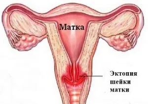 ерозія шийки матки лікування до вагітності ерозія шийки матки лікування до вагітності