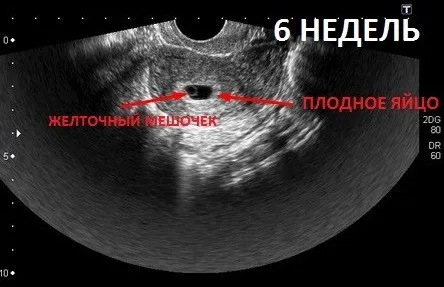 6 тиждень вагітності ознаки, ознаки відчуття відбувається акушерська шостий тиждень вагітності зачаття фото коричневі виділення ознаки відчуття відбувається акушерська шостий тиждень вагітності зачаття фото коричневі виділення