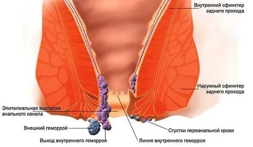 геморой у вагітних що робити