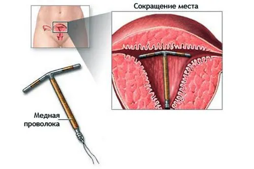 спіралі від вагітності