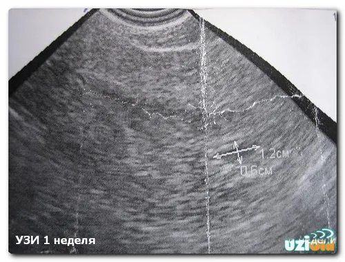 перші тижні вагітності узі