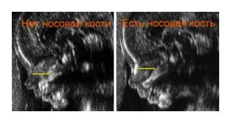 коли краще робити перше УЗД при вагітності