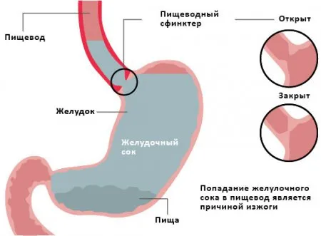 печія при вагітності