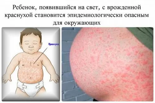 краснуха і вагітність