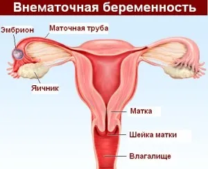 тест для визначення позаматкової вагітності