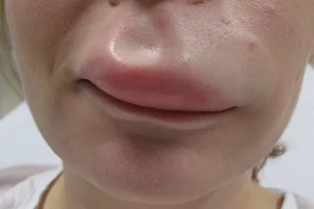 ангіоневротичнийнабряк при вагітності