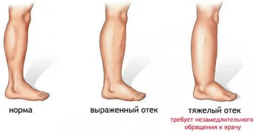 приховані набряки у вагітних, дієта вагітність час день розвантажувальний харчування білковий причина другої з'являтися прихований триместр пізній внутрішній третій викликаний симптом сильний фото ознака набряк вагітні приховані набряки у вагітних