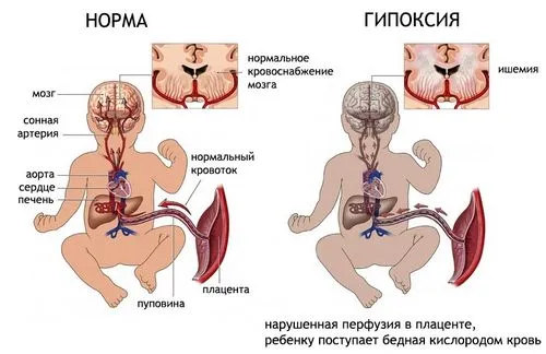 приношення вагітність наслідки