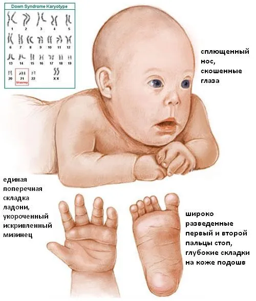 ознака синдром дауна плід узі що таке ризик народження як виявити