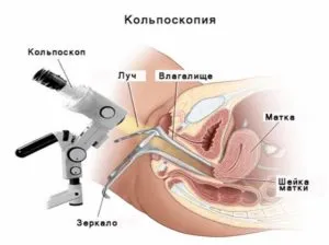 лікування ерозії шийки матки під час вагітності