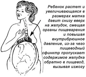 чому пече печія під час вагітності чому пече печія під час вагітності
