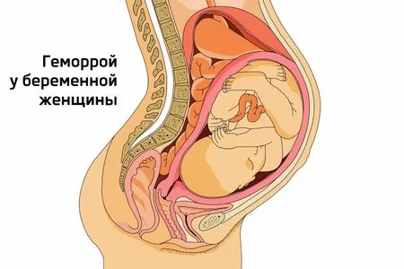 геморой при вагітності симптоми
