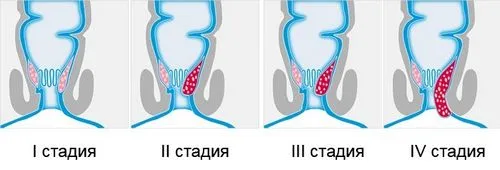 геморой у вагітних