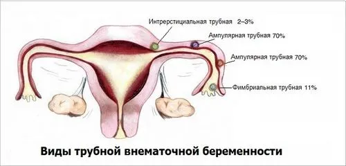 як визначити позаматкову вагітність