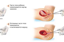 хвороби матки
