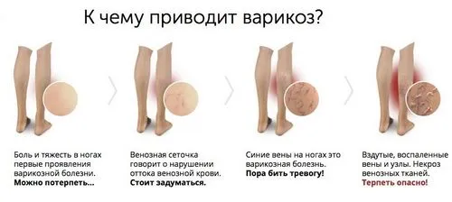як уникнути варикозу під час вагітності