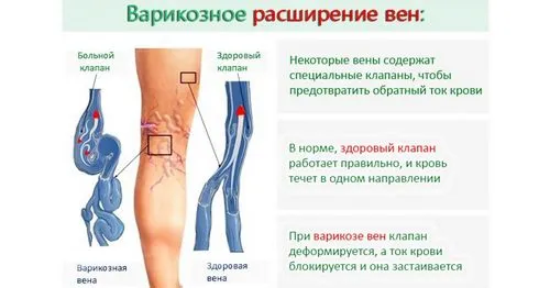як уникнути варикозу під час вагітності