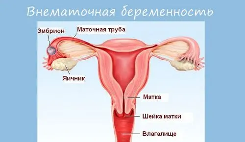 завмерла вагітність причини