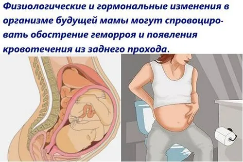 профілактика кровотеч під час вагітності