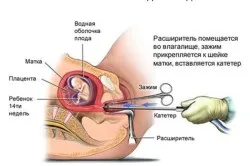 вагітність після чистки, перший по підлозі вагітність після чистки