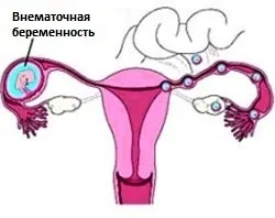 позаматкова вагітність операція